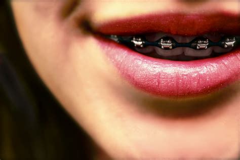 tipos de brackets